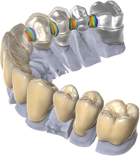 diseño protesis